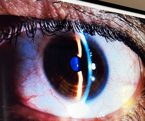 רויטל ויז'ן תוכנית לטיפול חדשני בעין עצלה מוכחת קלינית ומדעית כמשפרת את הראייה ובעלת אישור FDA ו- CE