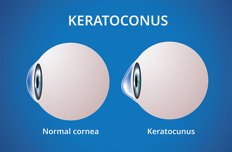 התאמת עדשות לקרטוקונוס מבצעים רק אצל אופטומטריסט מומחה קרטוקונוס ב-ב- M'Eye Clinic