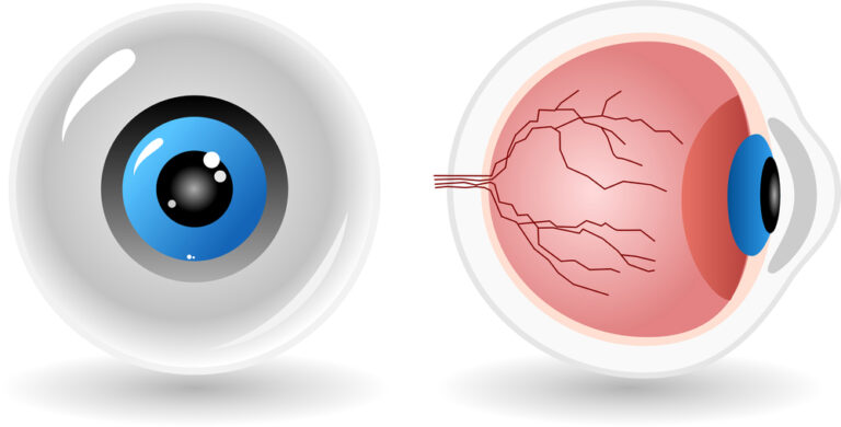 Medical illustration of keratoconus: comparison between a normal eye and a conical cornea deformity