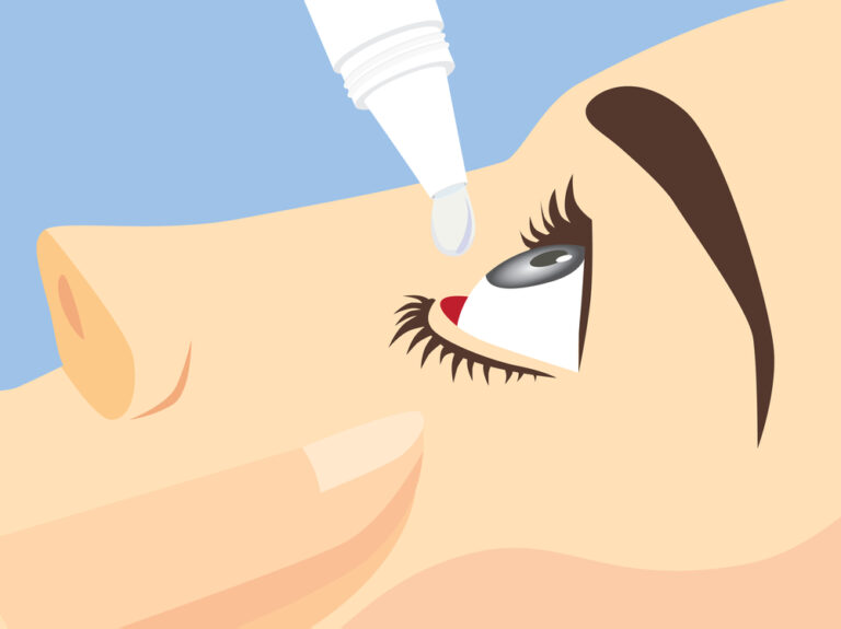 Illustration of a person applying eye drops to relieve dry eye symptoms