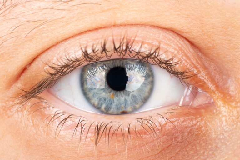 Close-up of an eye with visible keratoconus bulging in the cornea