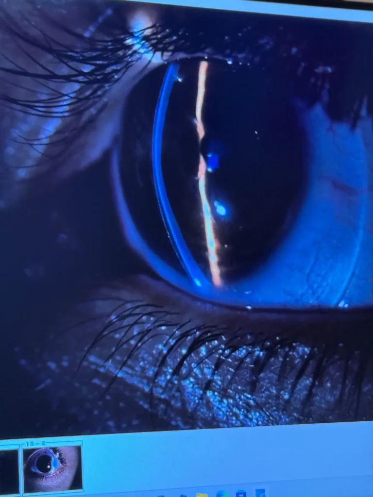Scleral lens fitting on an irregular cornea – advanced customization by MyClinic Middle East.
