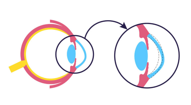 Illustration showing how keratoconus causes corneal thinning and bulging forward