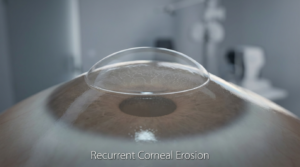 תקריב של הקרנית עם עדשה סקלרלית המדגימה שכבת נוזל והגנה במצבים של שחיקות קרנית חוזרות (RCE) הקשורות ל-EBMD.